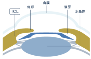 ICL手術とは？のICL挿入断面図解イラスト